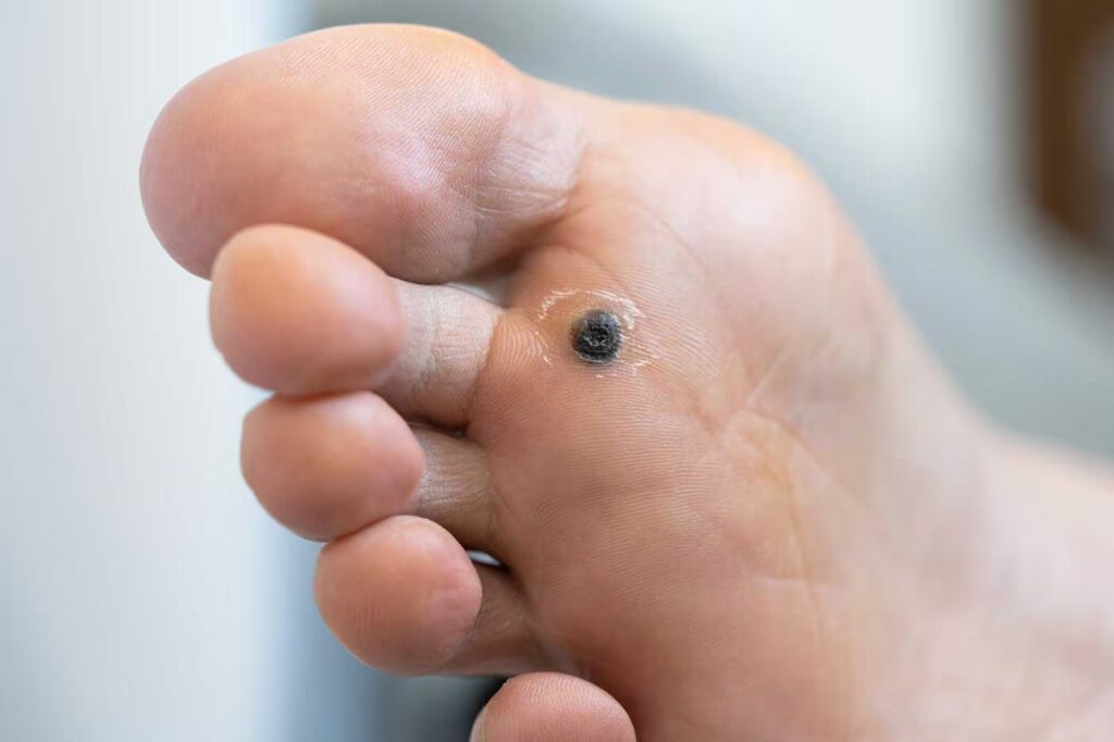 Plantar Warts & Verrucae 1 closeup of wart plantar after cauterizing it with 2025 03 10 05 54 51 utc