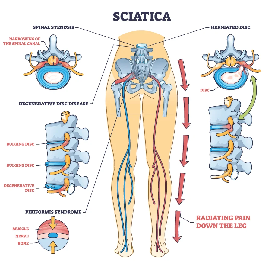 Sciatica Causes Shutterstock zAHmS9t8ARuGCsmzaHvUJAP1DlFA9f