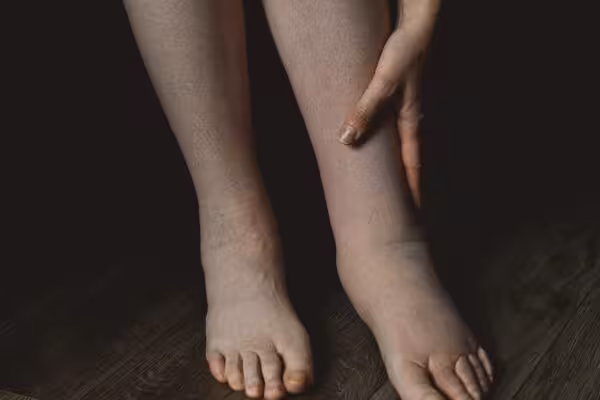 female legs affected by edema or lymphedema condit 2023 11 27 05 13 58 utc