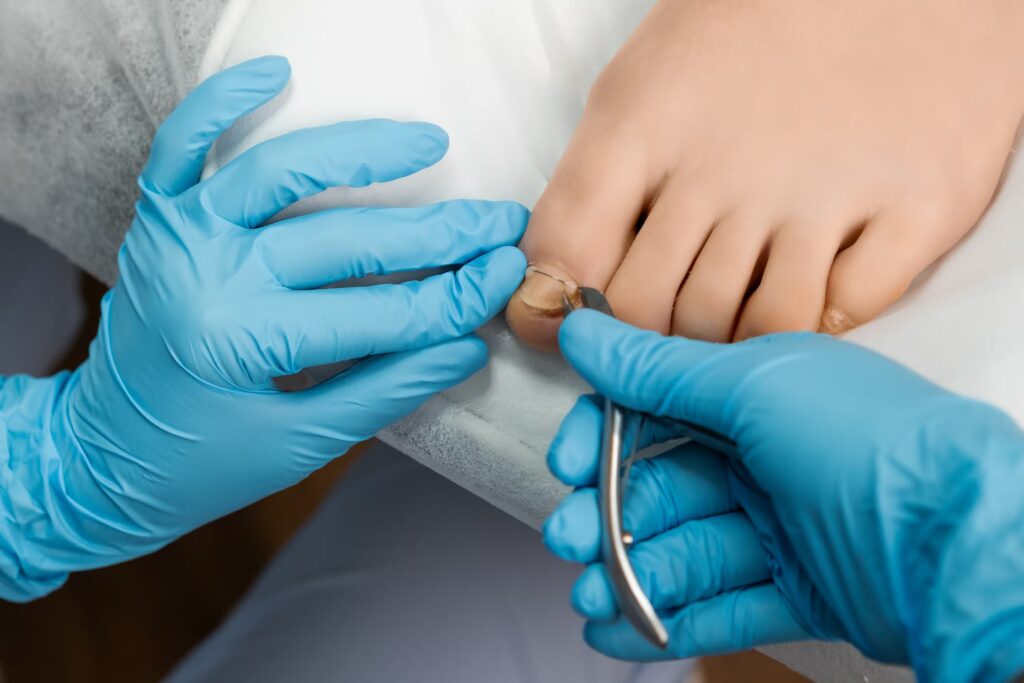 Ingrown Toenails 1 ingrown toenail procedure for female in beauty sal 2024 09 23 18 45 45 utc converted